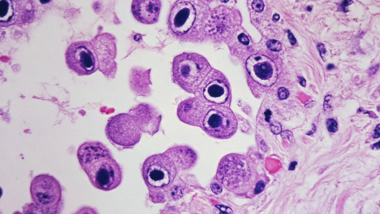 Cytomegalovirus
